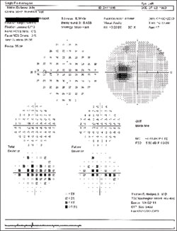 Figure 2. Humphrey 30-2 visual fields