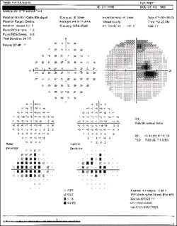 Figure 2. Humphrey 30-2 visual fields