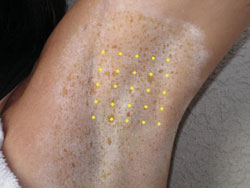 Figure 4. Botulinum toxin type A is injected into the targeted area in a grid pattern