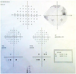 Figure 1. Humphrey visual field.