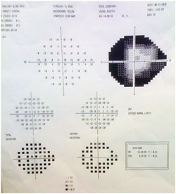 Figure 1. Humphrey visual field.