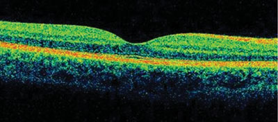 Figure 2. OCT of the left macula