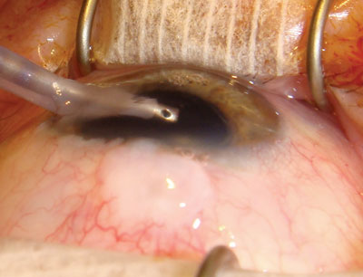 Cataract surgery is being performed on an eye with a history of glaucoma and a prior trabeculectomy with an active filtering bleb