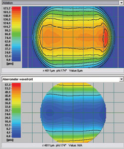 Figure 3. Mild amount of intraoperative change in the cyclotorsional alignment