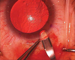 Figure 1. Scleral 5-mm wound.