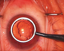 Figure 2. Marking cornea.