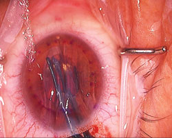 Figure 5. Charlie forceps.