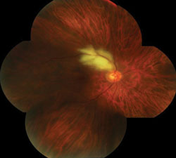 Figure 1a. Funduscopic photograph of the right eye revealed a full-thickness retinal infiltrate