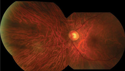 Figure 1b. A focal area of retinal whitening adjacent to a retinal vein was noted