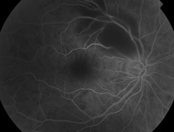 Figure 2a. Fluorescein angiography of the right eye demonstrating early hypofluorescence