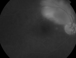 Figure 2b. Fluorescein angiography of the right eye demonstrating late hyperfluorescence and leakage