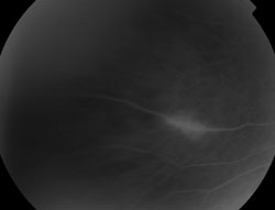 Figure 2c. Fluorescein angiography of the left eye demonstrating late hyperfluorescence and leakage of the lesion