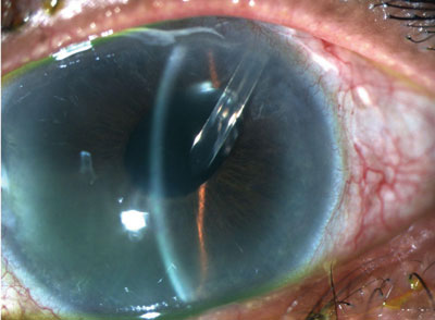 Figure 1. Anterior segment photograph of the left eye depicting iris atrophy and stromal splitting.