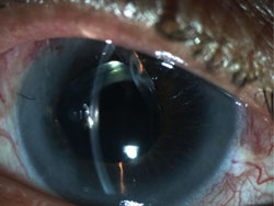 Figure 2. Anterior segment photographs of the right eye after Ahmed tube shunt placement depicting resolution of iridocorneal touch and peripheral anterior chamber deepening.