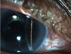 Figure 3. Anterior segment photographs of the right eye after Ahmed tube shunt placement depicting resolution of iridocorneal touch and peripheral anterior chamber deepening.