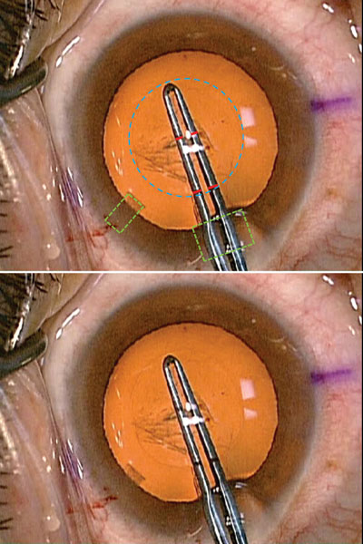 The top photo shows the 5-mm round capsulorrhexis (outlined in blue) is shifted slightly nasal in order to be well-centered on the visual axis. The capsulorrhexis forceps are marked at 2.5 mm and 5 mm from the tip (red marks) to facilitate intraocular measurements. 