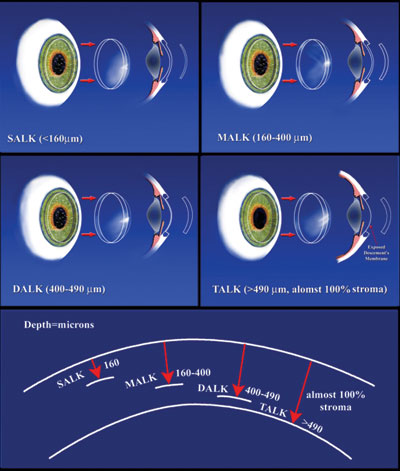 Figure 1. John-Malbran classification of anterior lamellar keratoplasty.