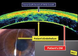 Figure 4. Corneal OCT after TALK procedure