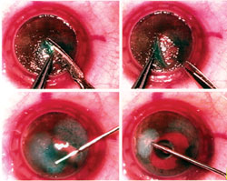 Figure 5. Fluid technique: Forced injection of sterile balanced salt solution intrastromally after stromal staining with indocyanine gree dye, and a layered dissection is carried out