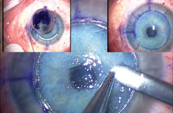 Figure 7. Trypan blue staining of the recipient corneal stroma (main figure), donor corneal endothelium (upper left insert) and a layered dissection approach are used to fully expose an intact recipient Descemet's membrane (upper right insert).