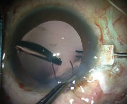 Figure 3. First haptic is held by an assistant while the surgeon flexes the second haptic into the anterior chamber in the jaws of the forceps