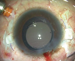 Figure 4. Both haptics are externalized and are then tucked into scleral tunnels made at the edge of the scleral flaps. 