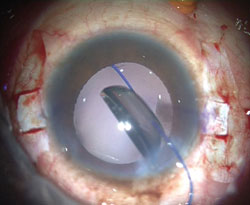 Figure 5. Another case showing the leading haptic lying free within the vitreous cavity.