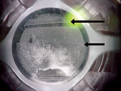 As seen by more generated opaque bubble layers, the second pass raster pattern has progressed to the center of the visual axis (short arrow). The opaque bubble layer from the first pass has partially dissipated in the inferior cornea and in the area treated after suction break (long arrow).