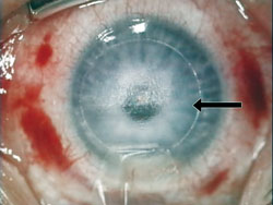 A horizontal junction (arrow) exists between the appearance of the twice treated superior stromal bed and once treated inferior bed. 