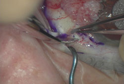 Figure 2. Conjunctival tumor being excised using Westcott scissors.