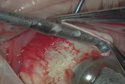 Figure 5. Application of cryotherapy to conjunctival margins.