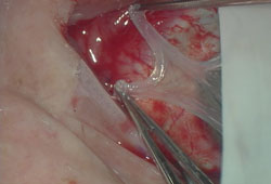 Figure 6. Amniotic membrane placed over defect with stromal side down.