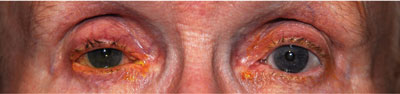 Figure 1.  External photographs revealing mild right upper eyelid ptosis and prominent right eyelid crusting.