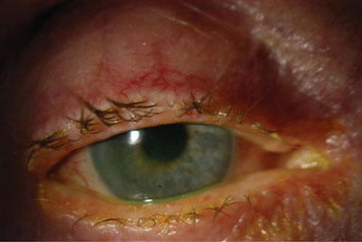 Figure 2.  External photograph of the right eye showing eyelid margin thickening, telangiectasias, madarosis and central corneal haze.