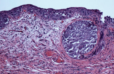 Figure 3.  H&E stain of conjunctival biopsy showing conjunctival epithelium with large cells and vesicular foamy, basophilic cytoplasm.