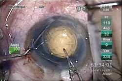 Figure 1. Surgeons rated three algorithms for lens fragmentation