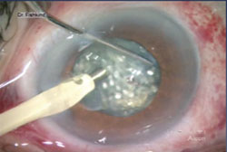 Figure 2. A spherical approach proved most effective in fragmenting grade-3 (moderate) cataracts