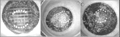 Figure 3. A pie-shaped cut proved most effective in fragmenting grade-4 (hard) cataracts