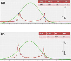 Figure 1. Although the ORA exam had normal corneal hysteresis and corneal resistance factor values, the waveform signal showed low amplitudes and weak signals in both eyes.