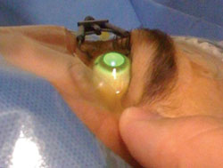 Figure 4. Collagen cross-linking procedure: UVA application.