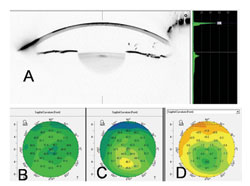 Figure 5. (A) Scheimpflug image 20 months after the procedure showing the demarcation line