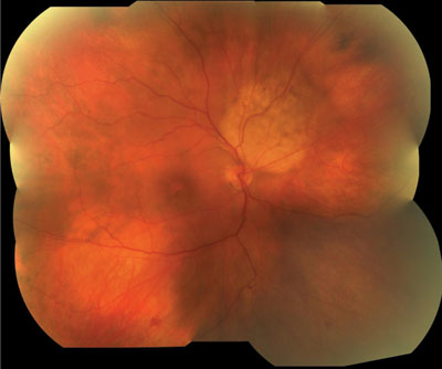 Figure 1.  Mosaic photograph of right eye. Blunted foveal reflex with retinal pigment epithelial changes.