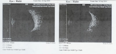 Figure 2.  B-scan of right eye. Solid mass elevated by 2 mm is seen in the posterior pole.