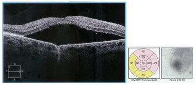 Figure 3. OCT of the right eye.