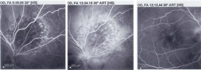 Figure 4.  Fluorescein angiography of right eye.