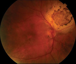 Figure 5.  Funduscopic image of right eye 1 month after treatment