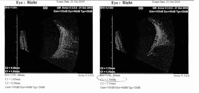 Figure 6.  B-scan of right eye 1 month after chemotherapy. 