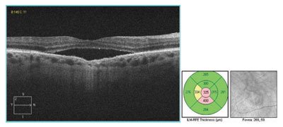 Figure 7.  OCT of the right eye 1 month after chemotherapy. 