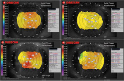 Figure 2. Before and after corneal topography. 