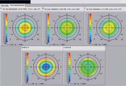 Figure 3a. The difference map between preop, 1-month and 1-year follow-ups showed fairly stable, predicted phoropter refraction and 2-D plots between the two postoperative follow-ups.